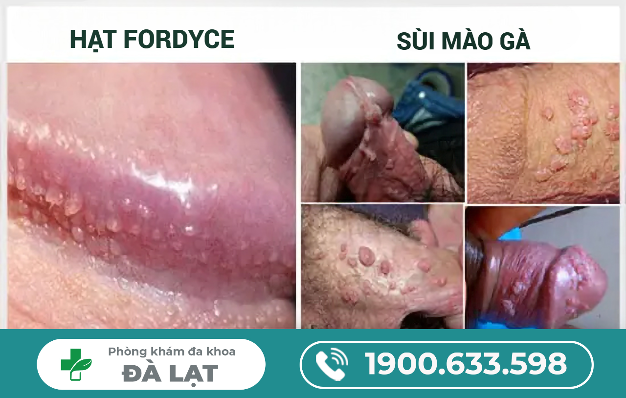 Phân Biệt Hạt Fordyce và Sùi Mào Gà 